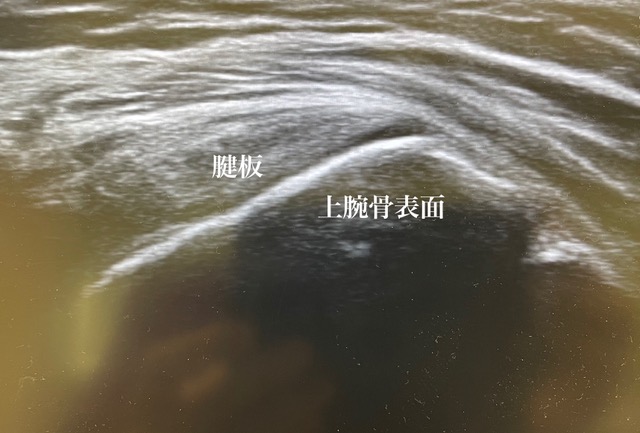 五十肩か腱板炎か?
